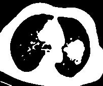 tumor